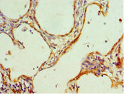 Immunohistochemistry of paraffin-embedded human cervical cancer using CSB-PA010576DSR2HU at dilution of 1:100