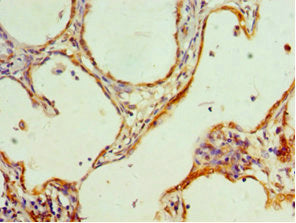Immunohistochemistry of paraffin-embedded human cervical cancer using CSB-PA010576DSR2HU at dilution of 1:100