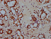 IHC image of CSB-PA010587LA01HU diluted at 1:300 and staining in paraffin-embedded human breast cancer performed on a Leica BondTM system. After dewaxing and hydration, antigen retrieval was mediated by high pressure in a citrate buffer (pH 6.0)....