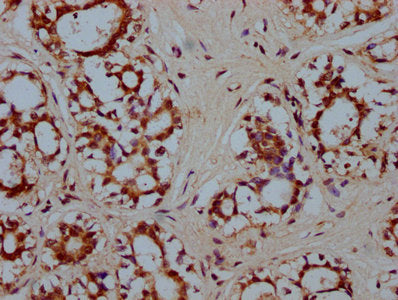 IHC image of CSB-PA010587LA01HU diluted at 1:300 and staining in paraffin-embedded human breast cancer performed on a Leica BondTM system. After dewaxing and hydration, antigen retrieval was mediated by high pressure in a citrate buffer (pH 6.0)....