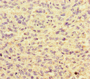 Immunohistochemistry of paraffin-embedded human melanoma using CSB-PA010608LA01HU at dilution of 1:100