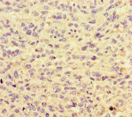 Immunohistochemistry of paraffin-embedded human melanoma using CSB-PA010608LA01HU at dilution of 1:100