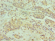 Immunohistochemistry of paraffin-embedded human breast cancer using CSB-PA010613ESR2HU at dilution of 1:100
