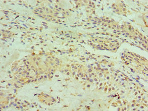 Immunohistochemistry of paraffin-embedded human breast cancer using CSB-PA010613ESR2HU at dilution of 1:100