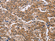 The image on the left is immunohistochemistry of paraffin-embedded Human liver cancer tissue using CSB-PA010637(EPDR1 Antibody) at dilution 1/40, on the right is treated with fusion protein. (Original magnification: ×200)
