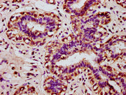 IHC image of CSB-PA010649LA01HU diluted at 1:100 and staining in paraffin-embedded human breast cancer performed on a Leica BondTM system. After dewaxing and hydration, antigen retrieval was mediated by high pressure in a citrate buffer (pH 6.0)....
