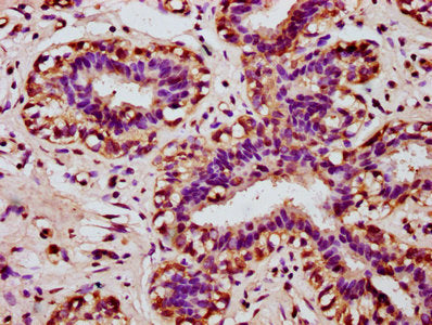 IHC image of CSB-PA010649LA01HU diluted at 1:100 and staining in paraffin-embedded human breast cancer performed on a Leica BondTM system. After dewaxing and hydration, antigen retrieval was mediated by high pressure in a citrate buffer (pH 6.0)....