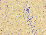 Immunohistochemistry of paraffin-embedded human liver cancer using CSB-PA010652LA01HU at dilution of 1:100