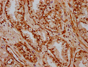 IHC image of CSB-PA010663LA01HU diluted at 1:600 and staining in paraffin-embedded human prostate cancer performed on a Leica BondTM system. After dewaxing and hydration, antigen retrieval was mediated by high pressure in a citrate buffer (pH 6.0)...