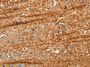 The image on the left is immunohistochemistry of paraffin-embedded Human brain tissue using CSB-PA010692(APC Antibody) at dilution 1/25, on the right is treated with synthetic peptide. (Original magnification: ×200)