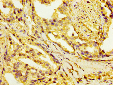 IHC image of CSB-PA010766LA01HU diluted at 1:100 and staining in paraffin-embedded human prostate cancer performed on a Leica BondTM system. After dewaxing and hydration, antigen retrieval was mediated by high pressure in a citrate buffer (pH 6.0)...