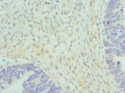 Immunohistochemistry of paraffin-embedded human ovarian cancer using CSB-PA010772ESR1HU at dilution of 1:100