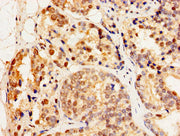 Immunohistochemistry of paraffin-embedded human prostate cancer using CSB-PA010792LA01HU at dilution of 1:100