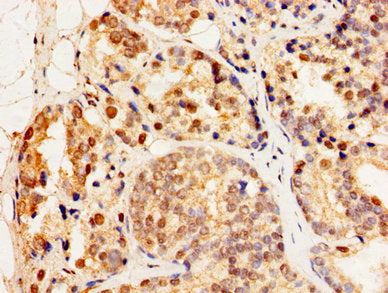 Immunohistochemistry of paraffin-embedded human prostate cancer using CSB-PA010792LA01HU at dilution of 1:100