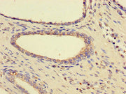 Immunohistochemistry of paraffin-embedded human prostate cancer using CSB-PA010830HA01HU at dilution of 1:100