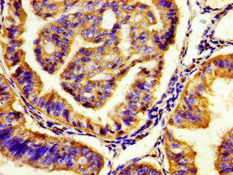 Immunohistochemistry of paraffin-embedded human endometrial cancer using CSB-PA010899LA01HU at dilution of 1:100