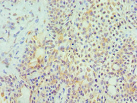 Immunohistochemistry of paraffin-embedded human breast cancer using CSB-PA010920ESR1HU at dilution of 1:100