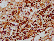 IHC image of CSB-PA010967LA01HU diluted at 1:1000 and staining in paraffin-embedded human breast cancer performed on a Leica BondTM system. After dewaxing and hydration, antigen retrieval was mediated by high pressure in a citrate buffer (pH 6.0)....