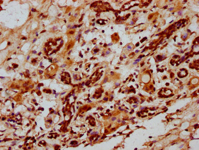 IHC image of CSB-PA010967LA01HU diluted at 1:1000 and staining in paraffin-embedded human breast cancer performed on a Leica BondTM system. After dewaxing and hydration, antigen retrieval was mediated by high pressure in a citrate buffer (pH 6.0)....