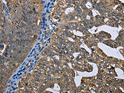 The image on the left is immunohistochemistry of paraffin-embedded Human ovarian cancer tissue using CSB-PA010968(GPAM Antibody) at dilution 1/60, on the right is treated with fusion protein. (Original magnification: ×200)