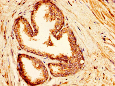 IHC image of CSB-PA011000LA01HU diluted at 1:300 and staining in paraffin-embedded human prostate cancer performed on a Leica BondTM system. After dewaxing and hydration, antigen retrieval was mediated by high pressure in a citrate buffer (pH 6.0)...