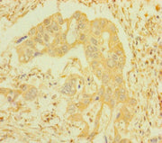 Immunohistochemistry of paraffin-embedded human pancreatic cancer using CSB-PA011028HA01HU at dilution of 1:100