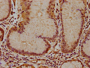 IHC image of CSB-PA011036LA01HU diluted at 1:100 and staining in paraffin-embedded human gastric cancer performed on a Leica BondTM system. After dewaxing and hydration, antigen retrieval was mediated by high pressure in a citrate buffer (pH 6.0)....