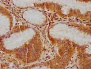 IHC image of CSB-PA011041NA01HU diluted at 1:100 and staining in paraffin-embedded human gastric cancer performed on a Leica BondTM system. After dewaxing and hydration, antigen retrieval was mediated by high pressure in a citrate buffer (pH 6.0)....