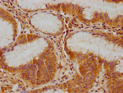 IHC image of CSB-PA011041NA01HU diluted at 1:100 and staining in paraffin-embedded human gastric cancer performed on a Leica BondTM system. After dewaxing and hydration, antigen retrieval was mediated by high pressure in a citrate buffer (pH 6.0)....