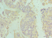 Immunohistochemistry of paraffin-embedded human endometrial cancer using CSB-PA011047ESR1HU at dilution of 1:100
