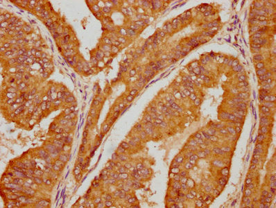 IHC image of CSB-PA011093LA01HU diluted at 1:100 and staining in paraffin-embedded human endometrial cancer performed on a Leica BondTM system. After dewaxing and hydration, antigen retrieval was mediated by high pressure in a citrate buffer (pH 6...