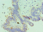 Immunohistochemistry of paraffin-embedded human colon cancer using CSB-PA011098ESR2HU at dilution of 1:100