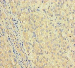Immunohistochemistry of paraffin-embedded human liver cancer using CSB-PA011156LA01HU at dilution of 1:100