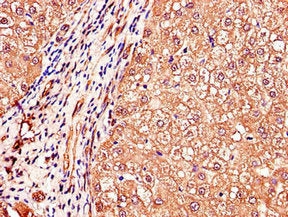 Immunohistochemistry of paraffin-embedded human liver cancer using CSB-PA011172LA01HU at dilution of 1:100
