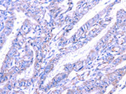 The image on the left is immunohistochemistry of paraffin-embedded Human esophagus cancer tissue using CSB-PA011317(THAP6 Antibody) at dilution 1/30, on the right is treated with fusion protein. (Original magnification: ×200)
