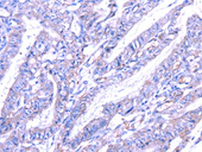The image on the left is immunohistochemistry of paraffin-embedded Human esophagus cancer tissue using CSB-PA011317(THAP6 Antibody) at dilution 1/30, on the right is treated with fusion protein. (Original magnification: ×200)