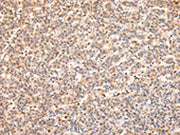 The image on the left is immunohistochemistry of paraffin-embedded Human liver cancer tissue using CSB-PA011436(RERE Antibody) at dilution 1/25, on the right is treated with synthetic peptide. (Original magnification: ×200)