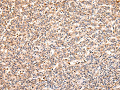 The image on the left is immunohistochemistry of paraffin-embedded Human liver cancer tissue using CSB-PA011436(RERE Antibody) at dilution 1/25, on the right is treated with synthetic peptide. (Original magnification: ×200)