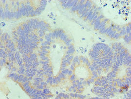 Immunohistochemistry of paraffin-embedded human colon cancer using CSB-PA011611ESR2HU at dilution of 1:100