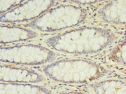 Immunohistochemistry of paraffin-embedded human colon cancer using CSB-PA011629LA01HU at dilution of 1:100