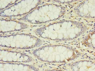 Immunohistochemistry of paraffin-embedded human colon cancer using CSB-PA011629LA01HU at dilution of 1:100