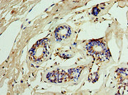 Immunohistochemistry of paraffin-embedded human breast cancer using CSB-PA011701ESR2HU at dilution of 1:100