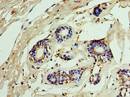 Immunohistochemistry of paraffin-embedded human breast cancer using CSB-PA011701ESR2HU at dilution of 1:100