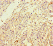 Immunohistochemistry of paraffin-embedded human pancreatic cancer using CSB-PA011732HA01HU at dilution of 1:100