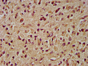 IHC image of CSB-PA011734LA01HU diluted at 1:400 and staining in paraffin-embedded human glioma performed on a Leica BondTM system. After dewaxing and hydration, antigen retrieval was mediated by high pressure in a citrate buffer (pH 6.0). Section...