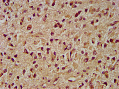IHC image of CSB-PA011734LA01HU diluted at 1:400 and staining in paraffin-embedded human glioma performed on a Leica BondTM system. After dewaxing and hydration, antigen retrieval was mediated by high pressure in a citrate buffer (pH 6.0). Section...