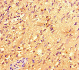 Immunohistochemistry of paraffin-embedded human glioma using CSB-PA011825LA01HU at dilution of 1:100
