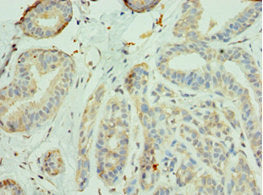 Immunohistochemistry of paraffin-embedded human breast cancer using CSB-PA011829DSR1HU at dilution of 1:100