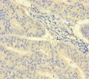 Immunohistochemistry of paraffin-embedded human endometrial cancer using CSB-PA011854LA01HU at dilution of 1:100