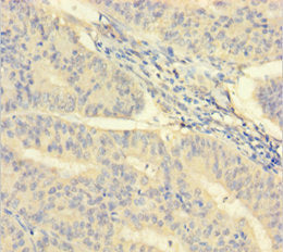 Immunohistochemistry of paraffin-embedded human endometrial cancer using CSB-PA011854LA01HU at dilution of 1:100